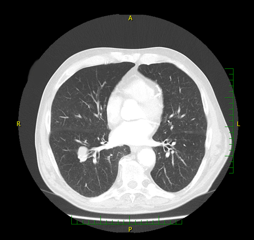CT pacienta 9 měsíců na 2. linii léčby