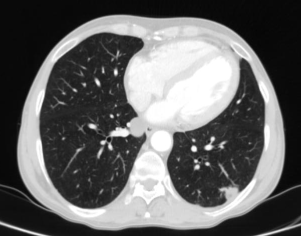CT - regrese v oblasti hrudníku