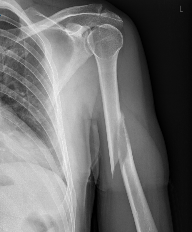 Patologická fraktura diafýzy P humeru