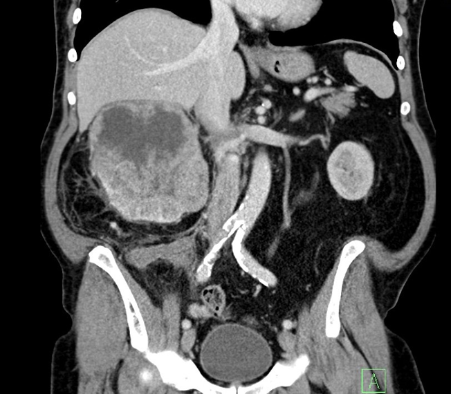 Původní CT před zahájením léčby